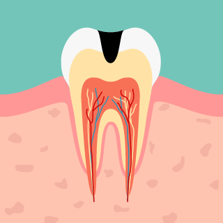 象牙質の虫歯