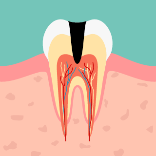 歯髄炎