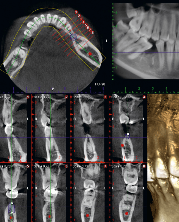 最新歯科用CT